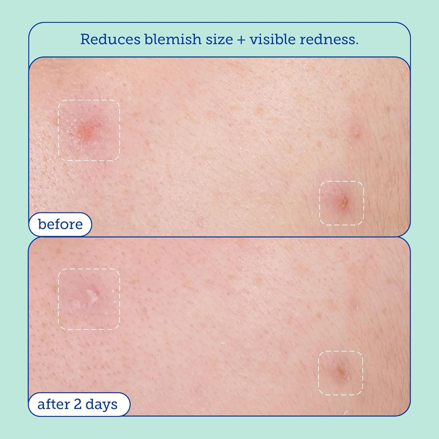 Skinfix Acne+ Gentle 2% Active Acne Spot Facial Treatment: Clinical-Strength, Acne Treatment that Nourishes & Reduces Blemish Size and Redness, Discourages New Acne Growth, 0.5 oz